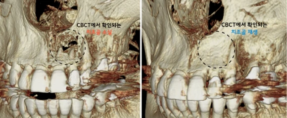 CBCT 3D — 치조골 소실 전후 비교