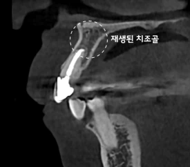 치료 후 CBCT — 회복이 확인된 치조골
