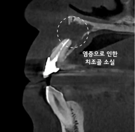 치료 전 CBCT — 염증으로 인한 치조골 소실